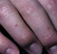 Image result for Flat Warts On Hands