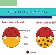 Image result for albyminuria