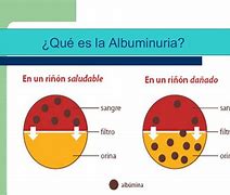 Image result for albuminuria
