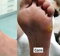 Image result for Corn vs Wart On Bottom of Foot