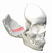 Image result for Occipital Encephalocele