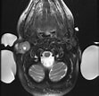 Bildergebnis für Teratome der Glandula parotitis. Größe: 111 x 107. Quelle: pacs.de
