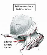 Image result for Anterior Wall of the External Meatus