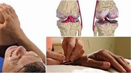 Image result for artralgia