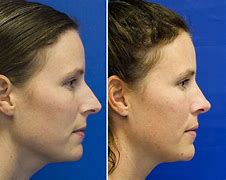 Image result for Sharp Pointed Nose
