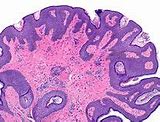 Image result for Lid Margin Papilloma