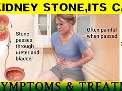Image result for Worst Case Kidney Stones