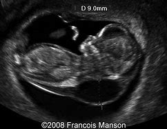 Image result for Cystic Hygroma Ultrasound Images