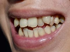 Image result for Byte Before and After Overlapped Teeth