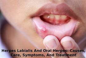 Image result for Herpes Labialis