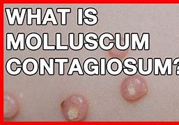 Image result for Molluscum Contagiosum in Groin Adult