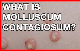 Image result for Molluscum Contagiosum On Black Skin