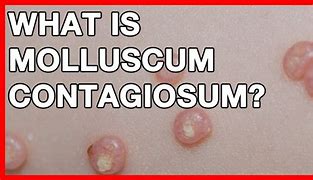 Image result for Molluscum Stages of Healing