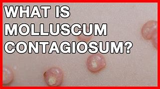 Image result for Inflamed Molluscum Contagiosum