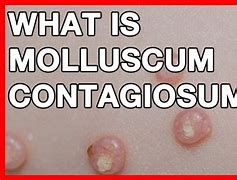 Image result for Molluscum Contagiosum