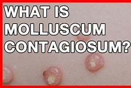 Image result for Molluscum Contagiosum in Tagalog