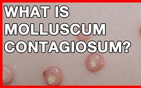 Image result for Molluscum Contagiosum Elbow