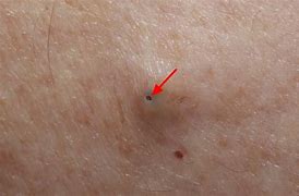 Image result for Armpit Cyst