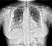 Image result for PICC Line CXR