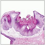 Image result for Molluscum Contagiosum Histology