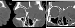 Image result for Sinonasal Papilloma Radiology