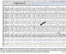 Image result for Triphasic Spikes On EEG