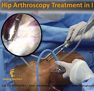 Image result for Arthroscopic Hip Surgery Recovery