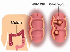 Image result for Burning Polyps in Colon