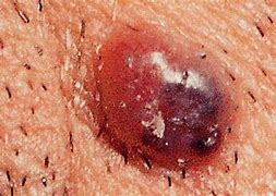 Image result for Lump Under Skin Melanoma