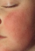 Image result for Fifth Disease Rash Pictures in Adults