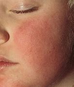 Image result for Fifth Disease Skin Rash
