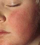 Image result for 5Ths Disease Rash On Face