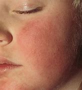 Image result for Fifth Disease Skin Rash