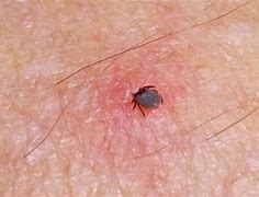 Image result for What Does a Tick Look Like in Skin