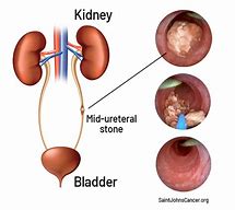 Image result for 7Mm Kidney Stone in Ureter Treat Men