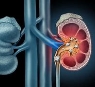 Image result for 7Mm Kidney Stone in Ureter Treat Men