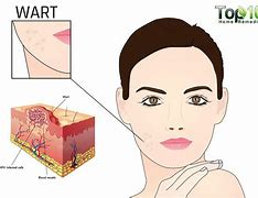 Image result for Flat Warts On Mouth