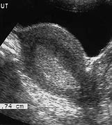 Image result for Endometrium Hyperplasia On Ultrasound Image