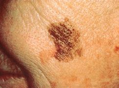 Image result for What Does Melanoma Skin Cancer Look Like