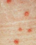 Image result for Molluscum Outbreak