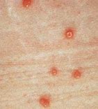 Image result for Pox Virus Molluscum