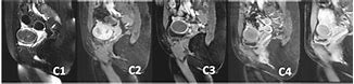 Image result for 6 Cm Fibroid