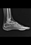 Image result for Wart in Feet