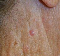 Image result for Types of Skin Cancer