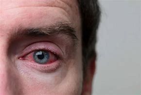 Image result for Chlamydia Eye Infection Symptoms