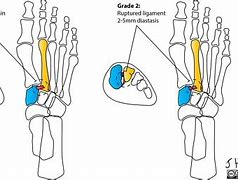 Image result for Lisfranc Fracture