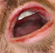 Image result for Erythema Multiforme