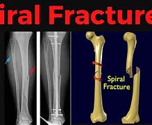 Image result for Spiral Fracture Incision Scar