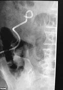 Image result for Uresil Nephrostomy Catheter