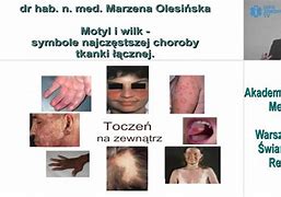 Image result for choroby_układowe_tkanki_łącznej